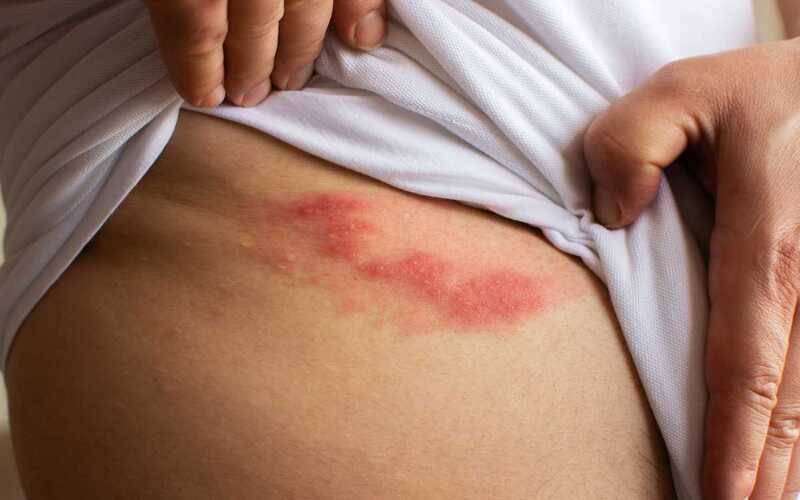 Herpes Zóster: entenda a doença, suas complicações e saiba onde se vacinar em Petrópol