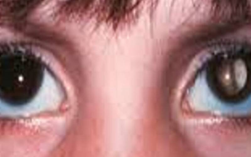 Retinoblastoma: Falta de exames na 1ª infância pode cegar