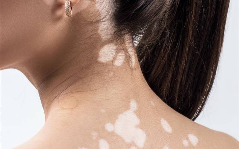 Pessoas com vitiligo terão prioridade em dermatologistas e psicólogos