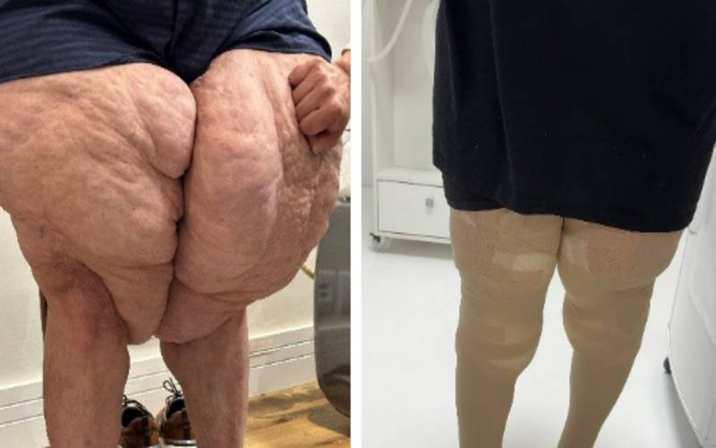 Lipedema em homens? Especialista explica caso raro diagnosticado no país