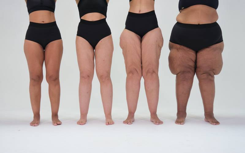 Lipedema: como evitar a progressão da doença por meio do diagnóstico precoce?