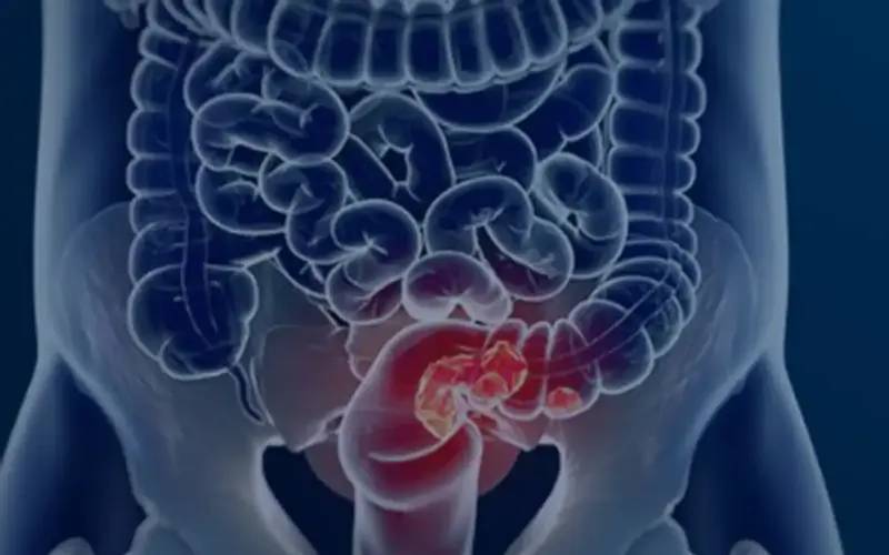Pacientes com câncer colorretal são diagnosticados em estágio avançado