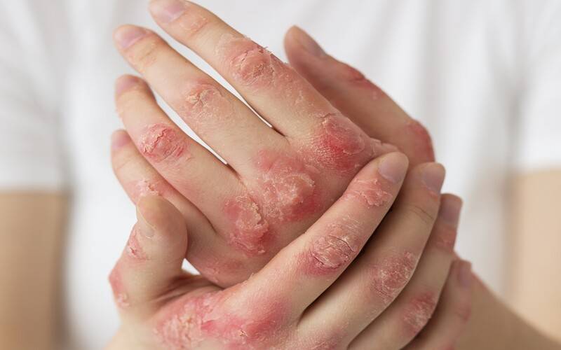 Dia do Combate e Prevenção da Hanseníase 