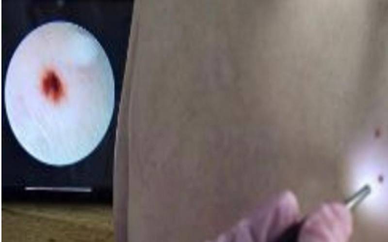 Busca tardia por dermatologista faz casos de câncer de pele chegarem mais avançados